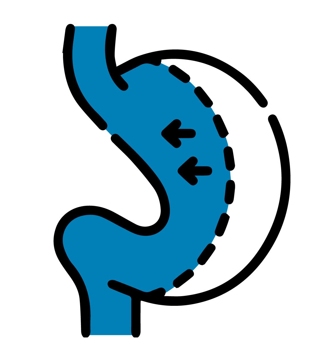 تكميم المعدة